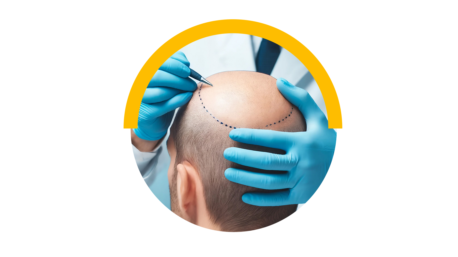 Hair Transplant